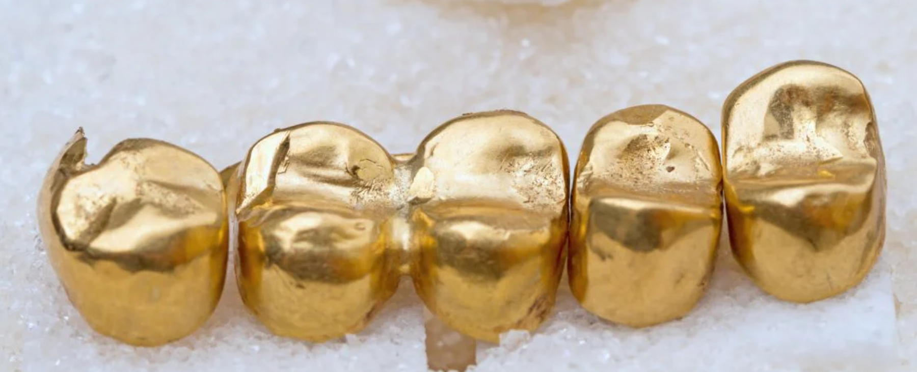 Uncovering the Hidden Value of Precious Metal Dental Scrap – Express ...